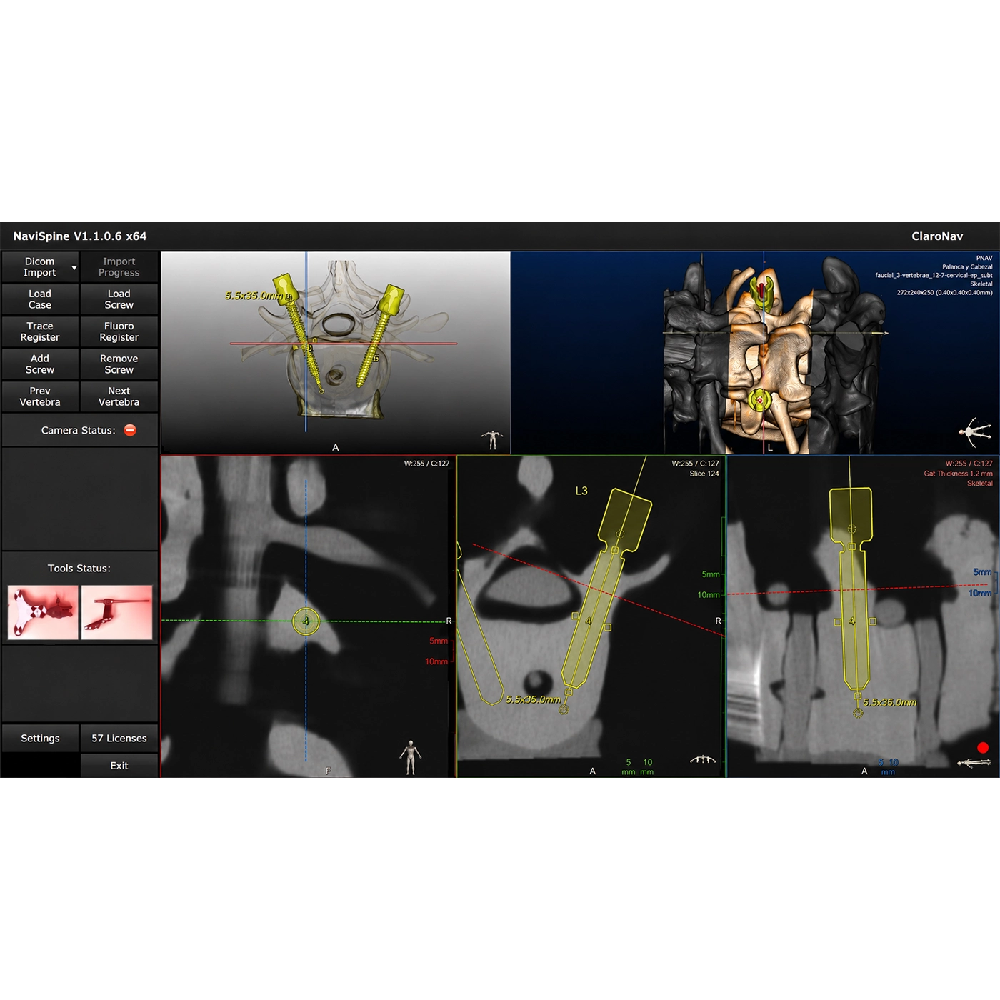 ClaroNav Navient® Optical Navigation System - Imagen 2